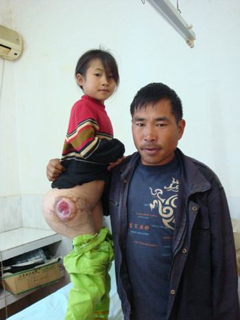 瑤家囡身長巨瘤八年引發“愛心接力”(組圖)