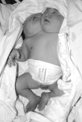 四川一孕婦生下“雙頭嬰兒”(圖)