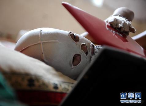 備受網友關注的“面具娃娃”回家休養