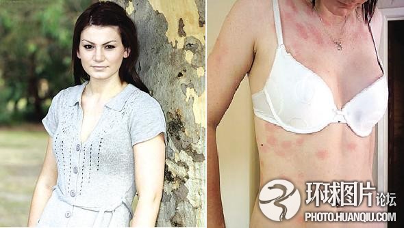 難以置信的罕見怪病：忘記呼吸 靜電過敏 聽鬧鐘響心臟停跳