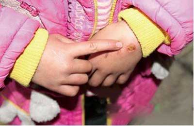 火鉗燙孩子，學前教育到底怎么了？