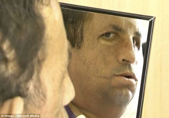 土耳其換臉人手術(shù)后首次長(zhǎng)出胡子