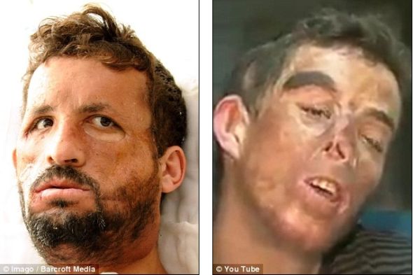 土耳其換臉人手術后首次長出胡子