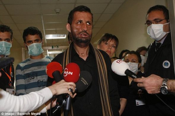 土耳其換臉人手術(shù)后首次長(zhǎng)出胡子