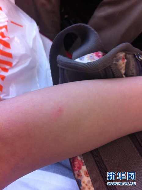 索尼RX100驚現(xiàn)“夾肉事件” 玩相機也流血?