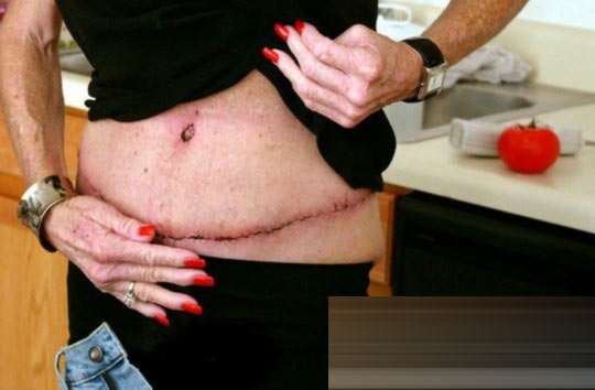 探秘國外令人觸目驚心的廉價整容