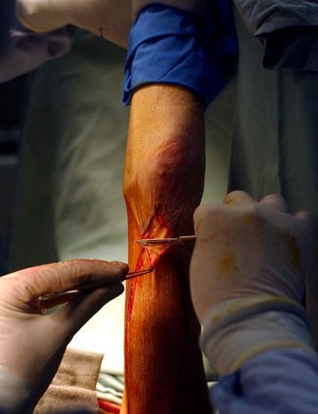 探秘國外令人觸目驚心的廉價整容