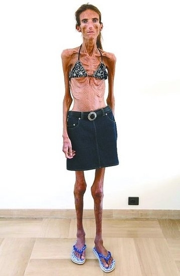 驚悚!女子減肥變