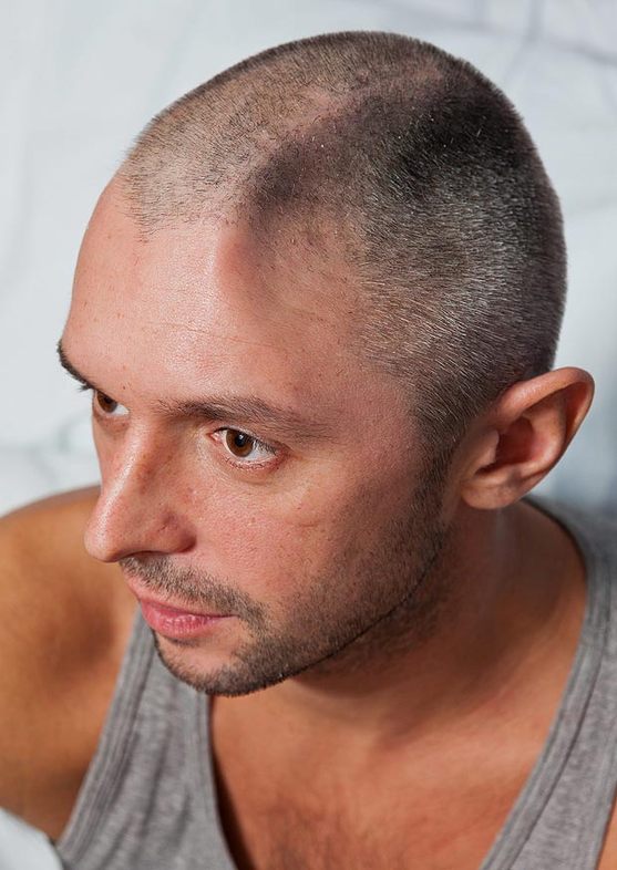 英男子陽(yáng)臺(tái)墜落致1/4頭蓋骨被切(組圖)