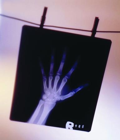 拍X光片時你穿防護服嗎？市民大多不知電離輻射危險