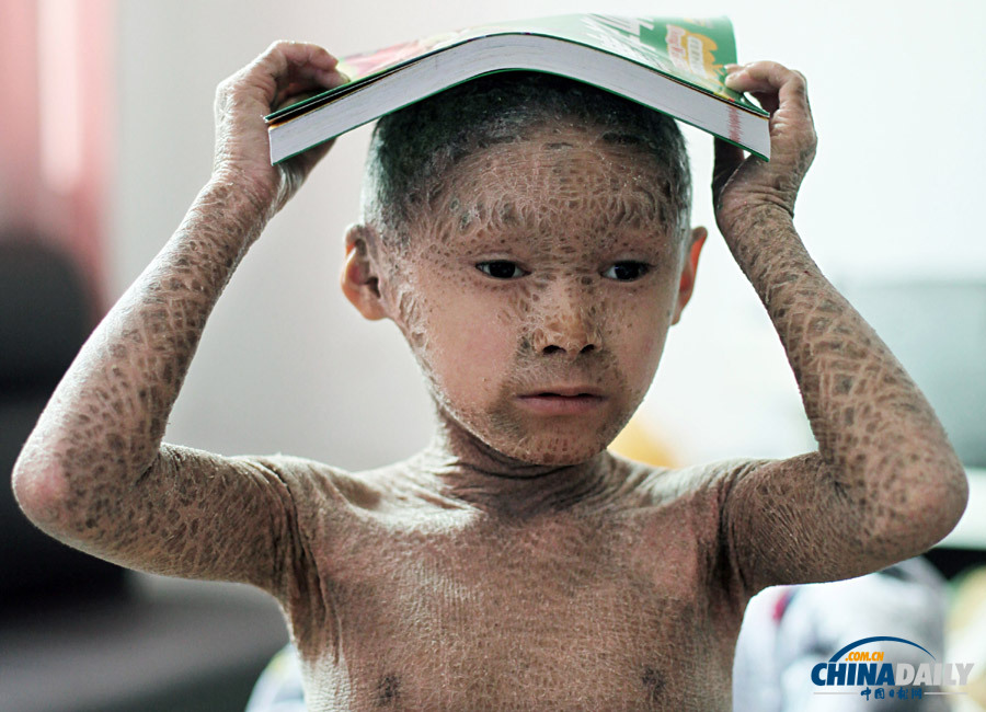 浙江溫嶺：“樹皮娃娃”渴望快樂童年