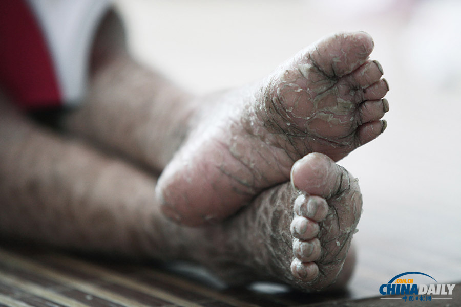 浙江溫嶺：“樹皮娃娃”渴望快樂童年