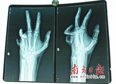 2歲孩子燙傷沒錢治 長大致手指畸形成“鬼爪”