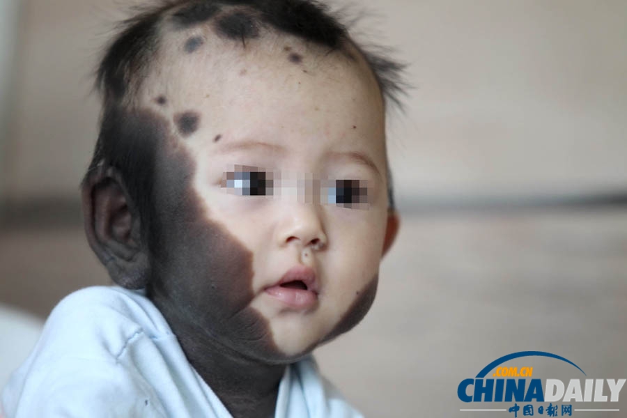 “斑點寶寶”赴上海求醫