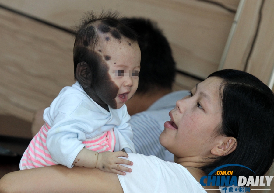 “斑點寶寶”赴上海求醫