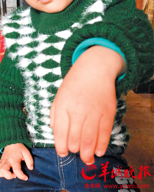 佛山兩歲童醫院慘斷指 欲上訴病歷竟被扣