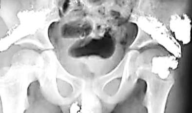 昆明疑被灌汞男童今天做手術 警方已立案調查