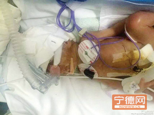 福鼎產(chǎn)婦26周早產(chǎn)雙胞胎女嬰 兩女嬰總體重不足3斤