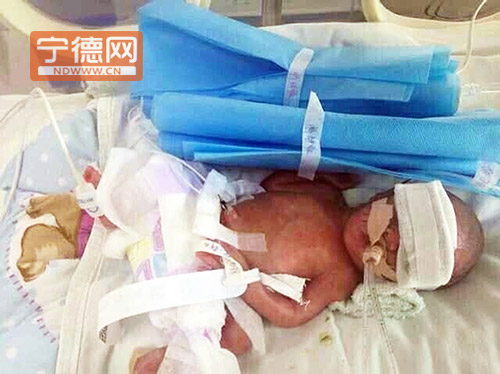 福鼎產(chǎn)婦26周早產(chǎn)雙胞胎女嬰 兩女嬰總體重不足3斤