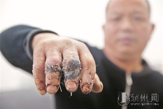 患者投訴醫(yī)院中指無名指錯接 醫(yī)院:要等鑒定結(jié)果