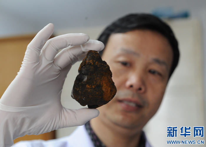 “拳頭”大的膽管結石