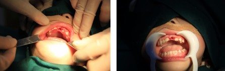 【無痛治牙】睡夢中13顆“壞牙”變“新牙” 寶寶看牙不怕不怕啦