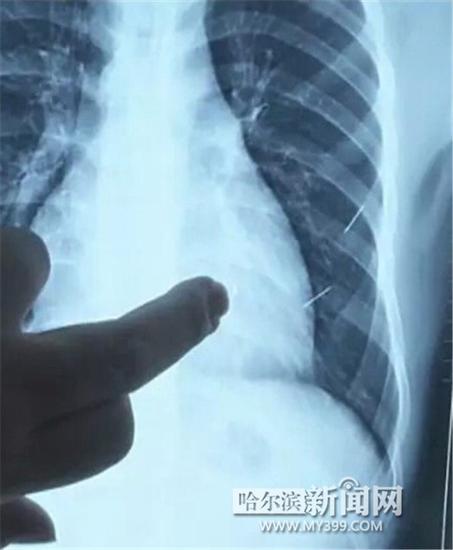 雙鴨山一少年體內(nèi)扎進(jìn)四根針 一根扎進(jìn)心臟4厘米(圖)