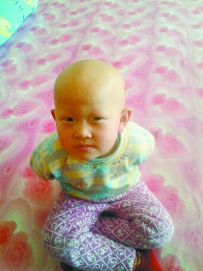 長春3歲女孩渾身毛發脫落