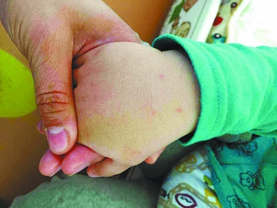 長春市偉才國際幼兒園多名孩子疑被“扎針”