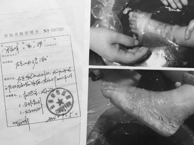 5歲男童幼兒園內(nèi)吃飯左腳踩進(jìn)湯桶 深Ⅱ度燙傷