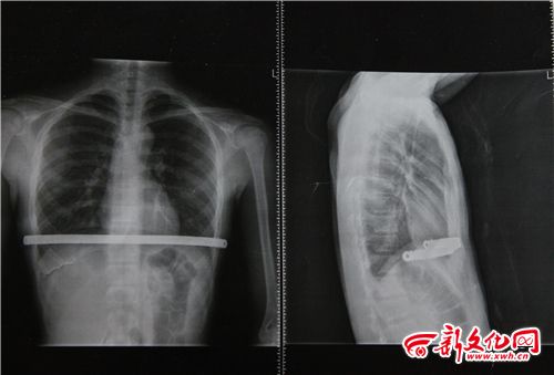 長春一初中生常莫名發(fā)燒40多度 病因仨月沒找到