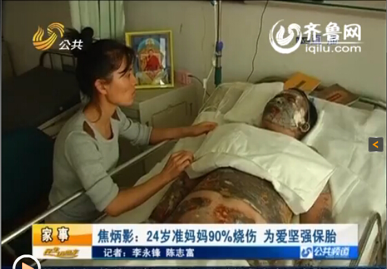 濰坊24歲準媽媽全身90%燒傷 丈夫婆婆離世為愛堅強保胎