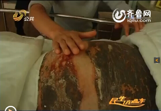 濰坊24歲準媽媽全身90%燒傷 丈夫婆婆離世為愛堅強保胎