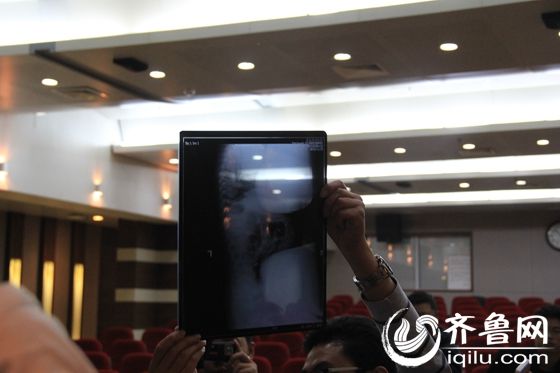 聊城針扎女?huà)腩A(yù)計(jì)一周內(nèi)康復(fù) 醫(yī)生建議關(guān)注心理問(wèn)題