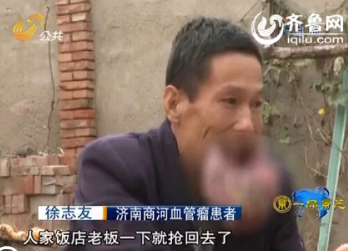 濟南:男子嘴唇長瘤50年未醫治 唇部腫脹比臉大