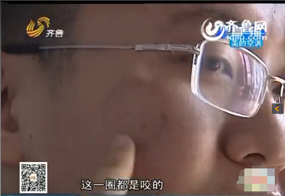 東營：男子與同事辦公室打架被咬臉 對方拒絕賠償