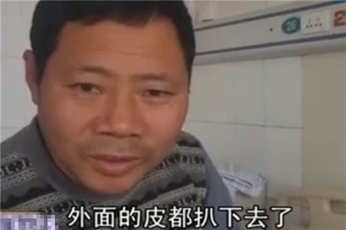 聊城兩歲半男孩雙手浸入油鍋 燙傷嚴重疼痛難耐