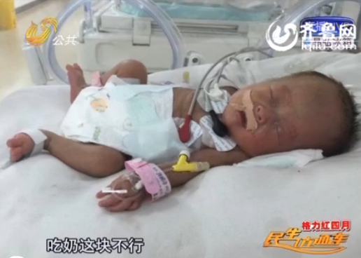 菏澤四胞胎中二女兒遭遇醫學難題 腦軟化已影響吃奶