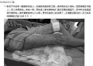 老人跌倒馬路隔著褲子仍被3度燙傷 需植皮