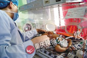 “雙頭女嬰”已可自主進食 醫生稱有望存活(圖)