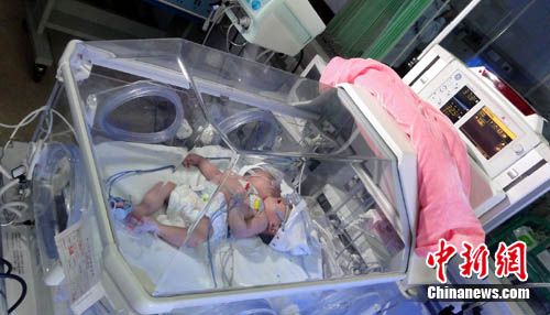 多地專家會診罕見“雙頭單體女嬰”(圖)