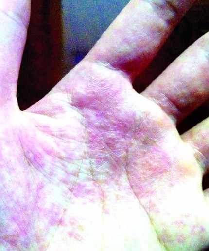 女白領(lǐng)一夜之間全身長(zhǎng)泡 工作壓力大螨蟲(chóng)入侵