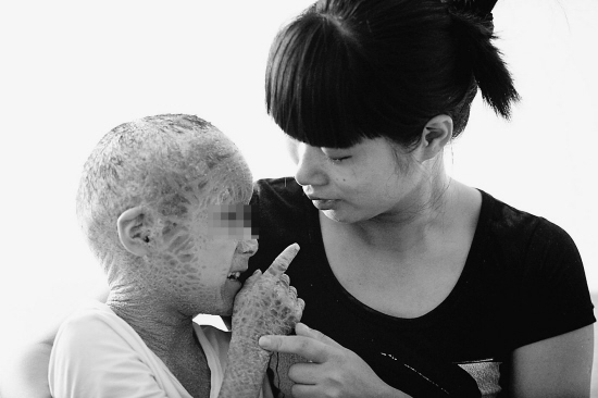 “樹皮娃娃”皮膚裂紋無數 不敢出門躲在家中(圖)