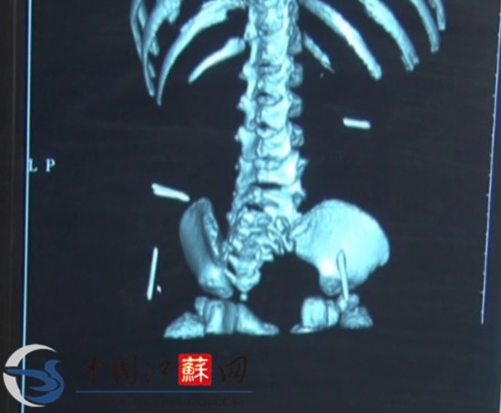 江蘇淮安女嬰體內(nèi)取出4根縫衣針 或?yàn)槿藶樵?/></font></p>

<p align=