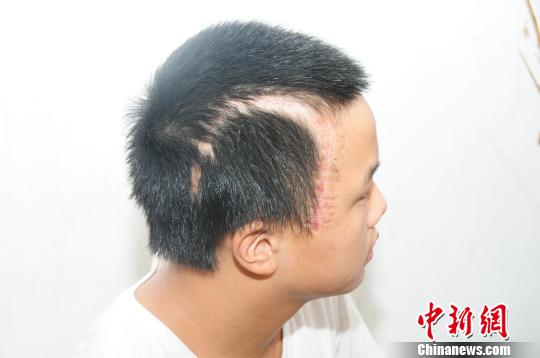 14歲男孩車禍重傷 因無(wú)力支付高額手術(shù)費(fèi)父拒認(rèn)子