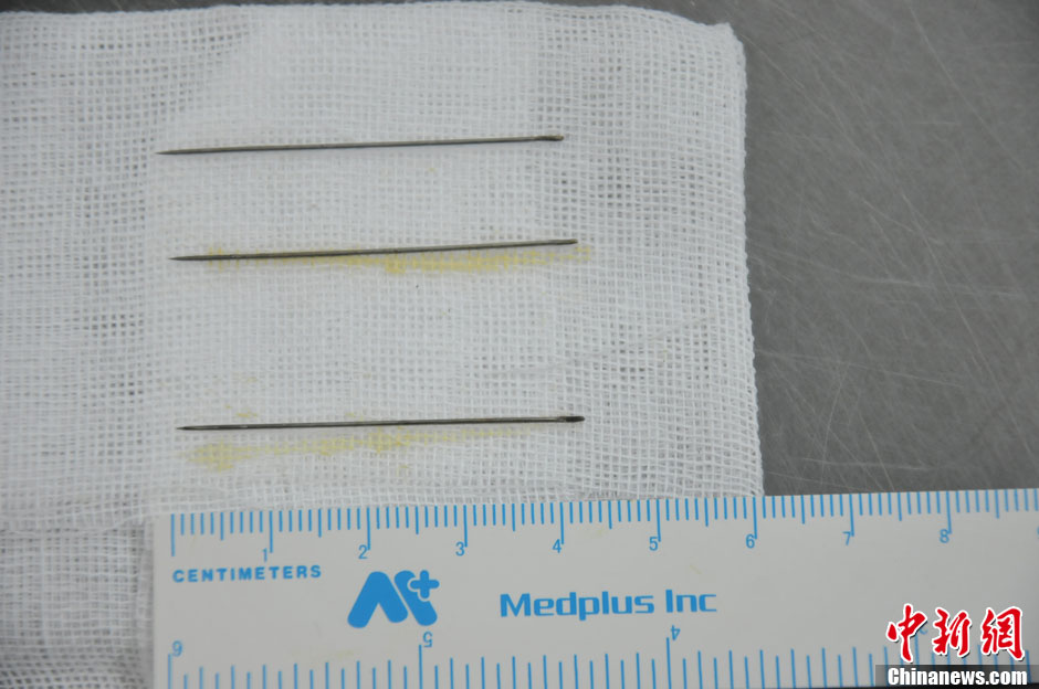 黑龍江被“縫衣針”扎傷女嬰手術成功