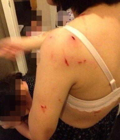 女子洗澡時浴室玻璃自爆 全身20多處被割傷(圖)