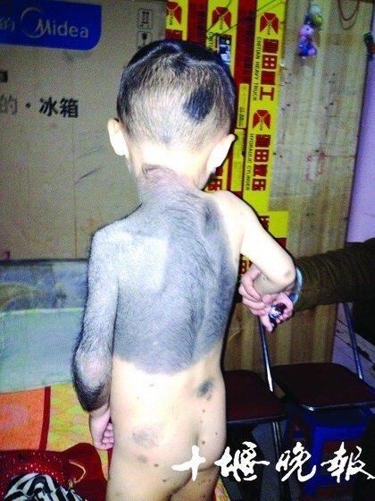4歲男孩渾身長黑毛 或患先天性巨大獸皮痣(圖)