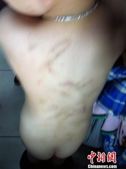 浙江4歲男童遭幼兒園老師暴打 遍體鱗傷