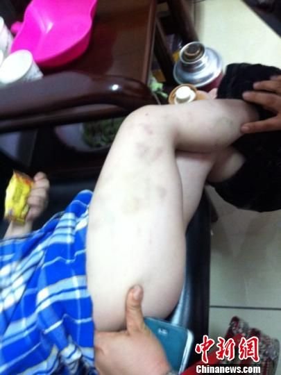 浙江4歲男童遭幼兒園老師暴打 遍體鱗傷